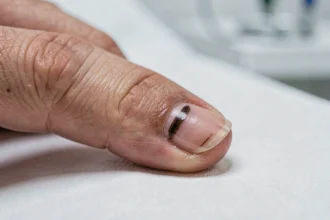 Gros plan sur un ongle présentant une tache noire sous-unguéale sur fond médical blanc
